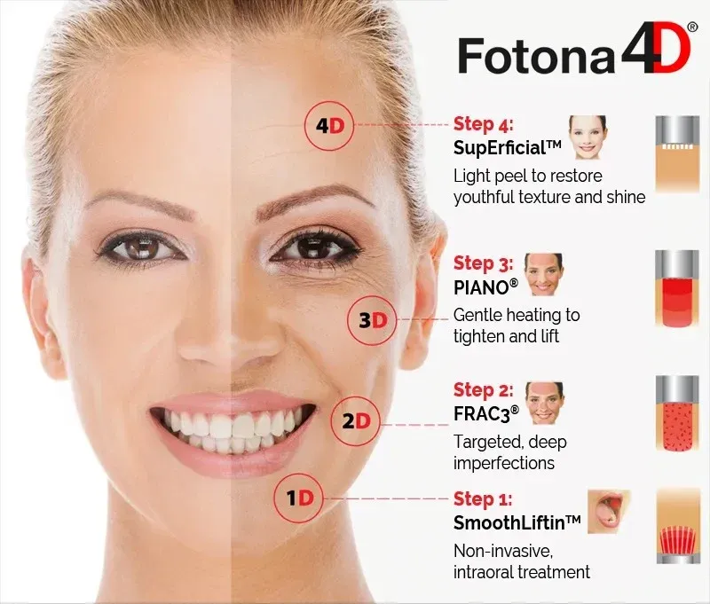 Fotona4D four-step facial rejuvenation diagram showing SmoothLiftin, FRAC3, PIANO and SupErficial treatment modes
