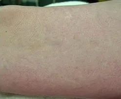 Fotona official spider vein removal follow-up; illustrative only