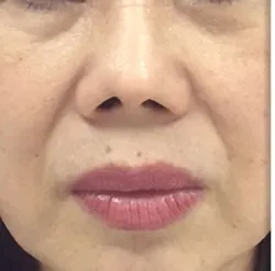 Fotona official Fotona4D clinical result 1 baseline; illustrative only