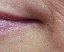 Fotona official hemangioma treatment follow-up; illustrative only