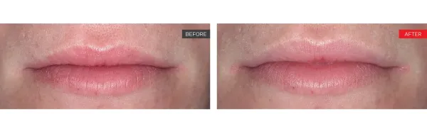 lip Before and After