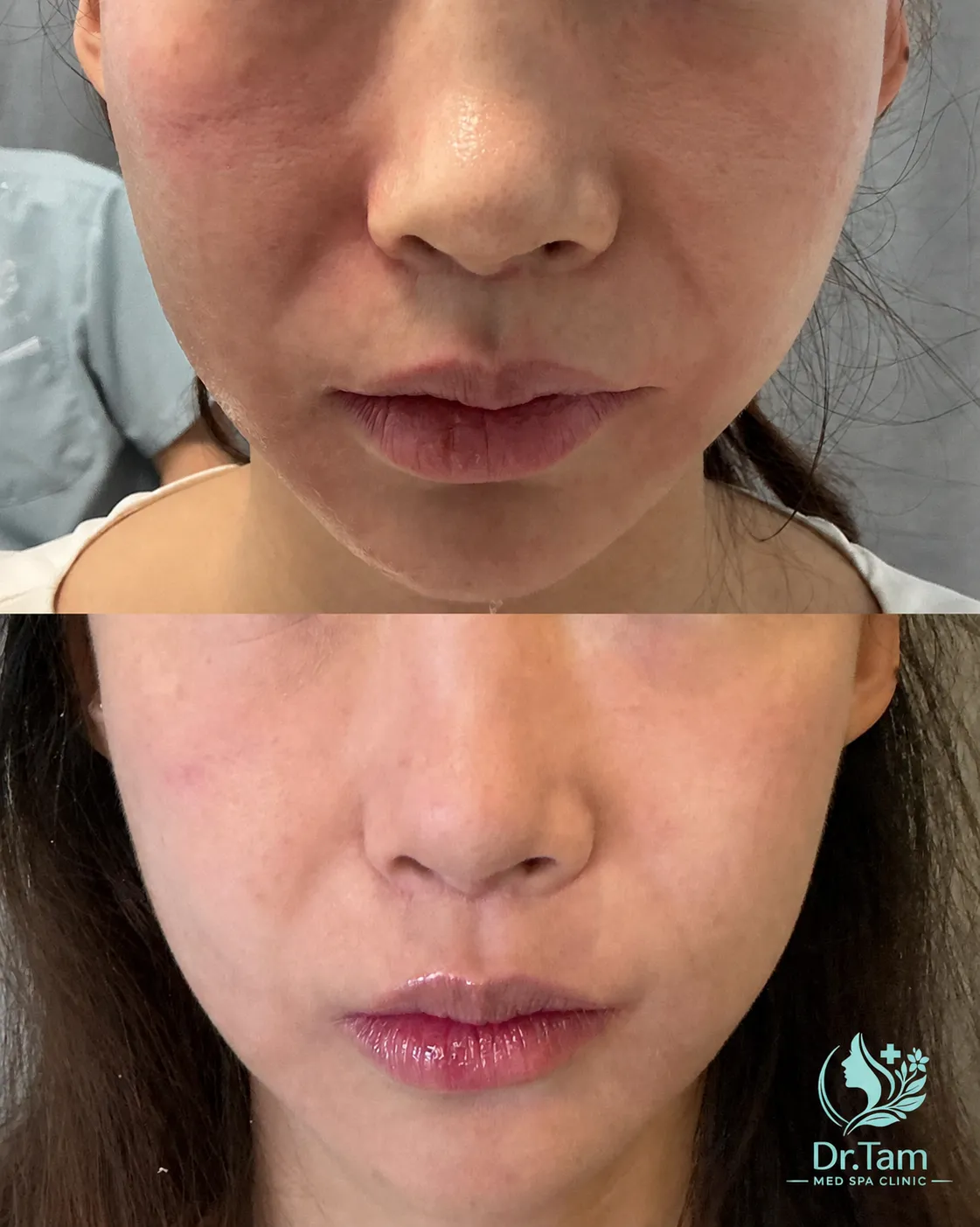 Patient-authorized before-and-after lower-face photographs associated with a Thermage treatment, with Dr Tam Med Spa Clinic logo watermark