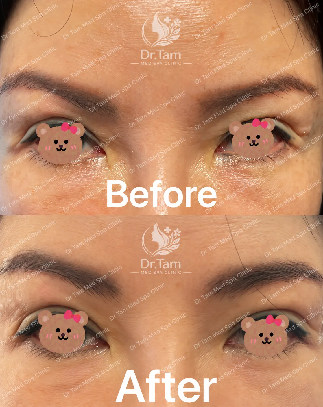 Patient-authorized before-and-after eye-area photographs associated with a Thermage treatment, with Dr Tam Med Spa Clinic watermarks and logo