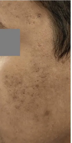 Fotona acne case 6 baseline; illustrative only