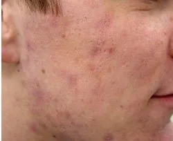 Fotona acne case 5 follow-up; illustrative only