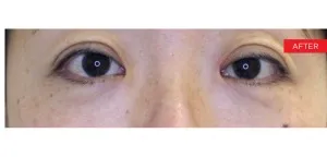 Fotona official SmoothEye Clinical Results case 2, follow-up image; illustrative only