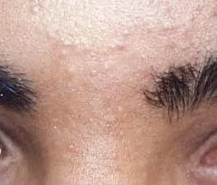 Fotona official eyebrow-area hair reduction follow-up image; illustrative only, not a Dr Tam Medical Spa patient result