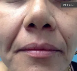 Fotona official Fotona4D clinical result 2 baseline; illustrative only