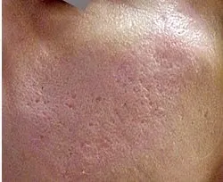 Fotona acne case 2 follow-up; illustrative only