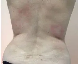 Fotona official TightSculpting Clinical Results case 4, follow-up image; illustrative only, not a Dr Tam patient result