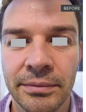 Fotona official Fotona4D clinical result 6 baseline; illustrative only