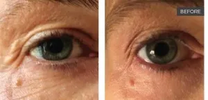Fotona official SmoothEye Clinical Results case 4, baseline image; illustrative only