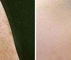 Fotona official bikini-area hair reduction baseline image; illustrative only, not a Dr Tam Medical Spa patient result
