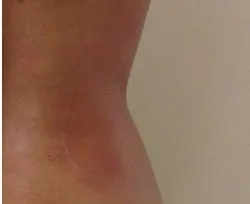 Fotona official TightSculpting Clinical Results case 3, follow-up image; illustrative only, not a Dr Tam patient result