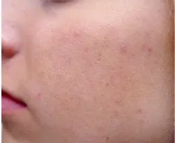 Fotona acne case 1 follow-up; illustrative only
