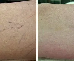 Fotona official spider vein removal baseline; illustrative only