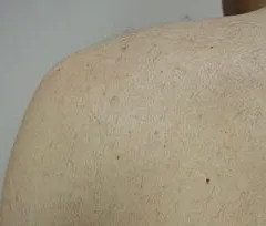 Fotona official shoulder-area hair reduction follow-up image; illustrative only, not a Dr Tam Medical Spa patient result