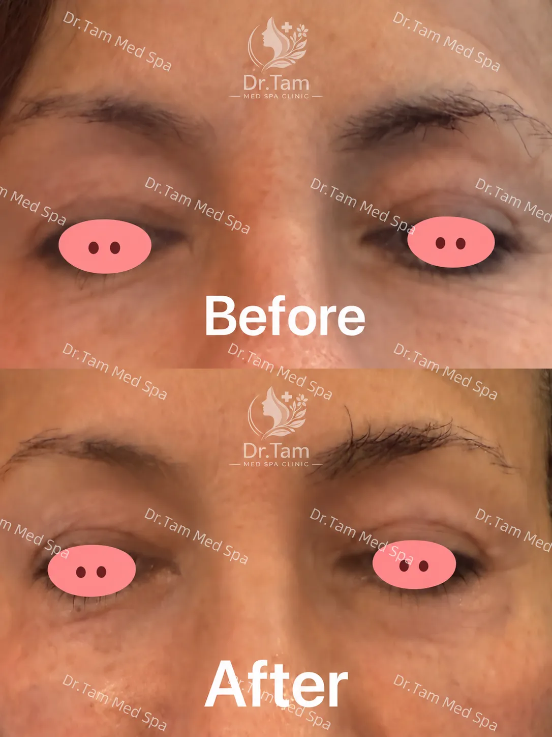 Patient-authorized before-and-after eye-area photographs associated with a Thermage treatment, with Dr Tam Med Spa Clinic watermark and logo