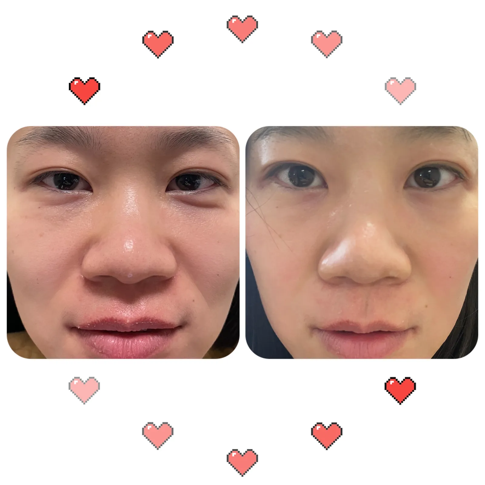 Fotona 4d full face 3 times