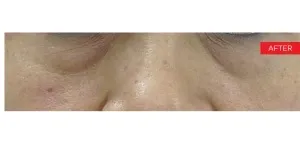 Fotona official SmoothEye Clinical Results case 3, follow-up image; illustrative only, not a Dr Tam patient result