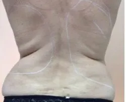 Fotona official TightSculpting Clinical Results case 4, baseline image; illustrative only, not a Dr Tam patient result
