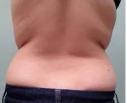 Fotona official TightSculpting Clinical Results case 1, baseline image; illustrative only, not a Dr Tam patient result