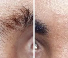 Fotona official eyebrow-area hair reduction baseline image; illustrative only, not a Dr Tam Medical Spa patient result