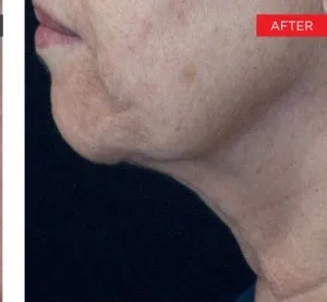 Fotona official Fotona4D clinical result 5 follow-up; illustrative only