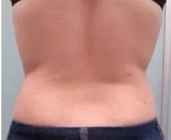 Fotona official TightSculpting Clinical Results case 1, follow-up image; illustrative only, not a Dr Tam patient result