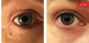 Fotona official SmoothEye Clinical Results case 4, follow-up image; illustrative only