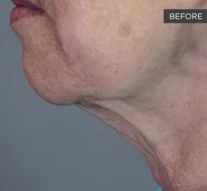 Fotona official Fotona4D clinical result 5 baseline; illustrative only