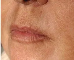 Fotona official Skin Resurfacing Clinical Results case 2, follow-up image; illustrative only, not a Dr Tam patient result