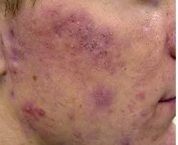Fotona acne case 5 baseline; illustrative only