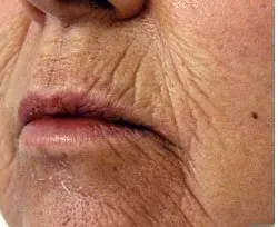 Fotona official Skin Resurfacing Clinical Results case 2, baseline image; illustrative only, not a Dr Tam patient result