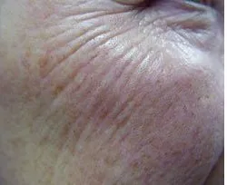 Fotona official Skin Resurfacing Clinical Results case 3, baseline image; illustrative only, not a Dr Tam patient result