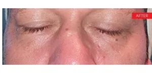 Fotona official SmoothEye Clinical Results case 1, follow-up image; illustrative only, 