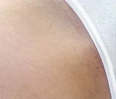 Fotona official bikini-area hair reduction follow-up image; illustrative only, not a Dr Tam Medical Spa patient result