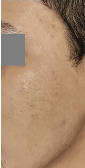Fotona acne case 6 follow-up; illustrative only