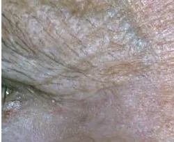 Fotona official Skin Resurfacing Clinical Results case 1, follow-up image; illustrative only, not a Dr Tam patient result