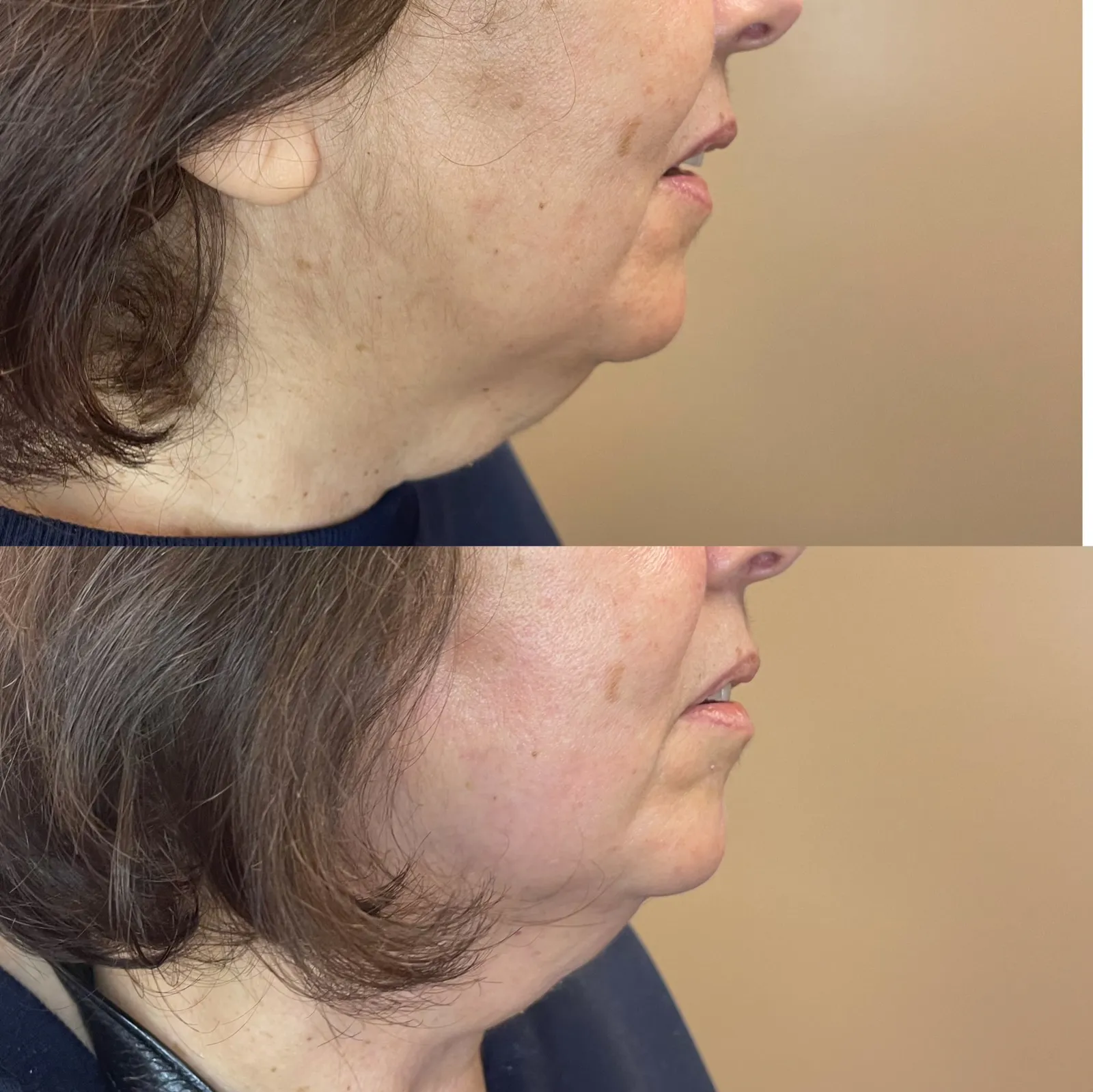 Fotona double chin 3 times