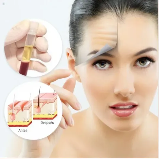 PRP TREATMENT