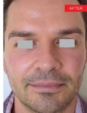 Fotona official Fotona4D clinical result 6 follow-up; illustrative only