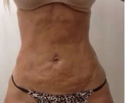 Fotona official TightSculpting Clinical Results case 2, baseline image; illustrative only, not a Dr Tam patient result