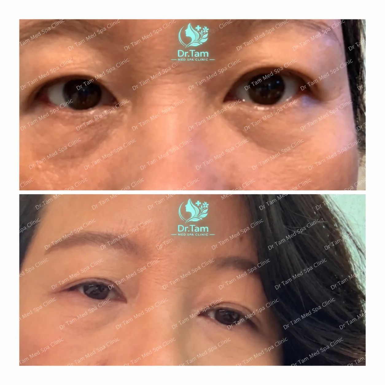Patient-authorized before-and-after eye-area photographs associated with a Thermage treatment, with Dr Tam Med Spa Clinic watermark and logo