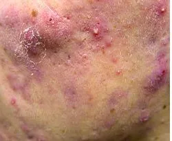 Fotona acne case 3 baseline; illustrative only