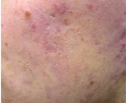 Fotona acne case 3 follow-up; illustrative only