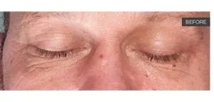 Fotona official SmoothEye Clinical Results case 1, baseline image; illustrative only,