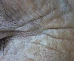 Fotona official Skin Resurfacing Clinical Results case 1, baseline image; illustrative only