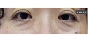 Fotona official SmoothEye Clinical Results case 2, baseline image; illustrative only
