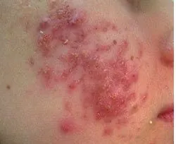 Fotona acne case 4 baseline; illustrative only